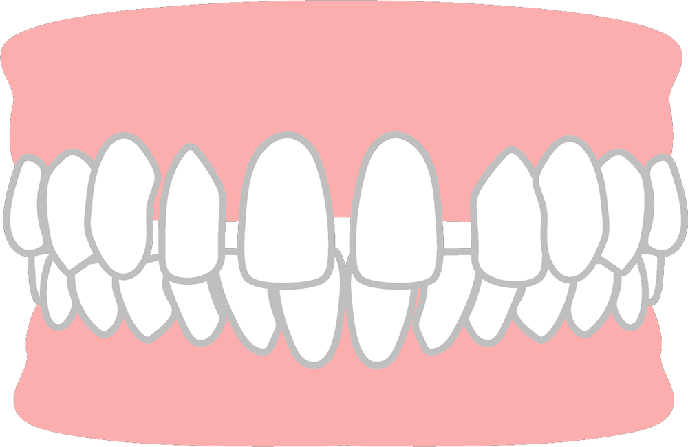 空隙歯列（くうげきしれつ）